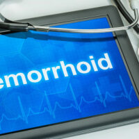 Best ways to manage hemorrhoids